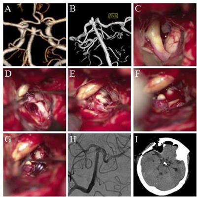 The Dolenc technique was used to clip 14 cases of ruptured basilar apex aneurysms and posterior cerebral artery aneurysms